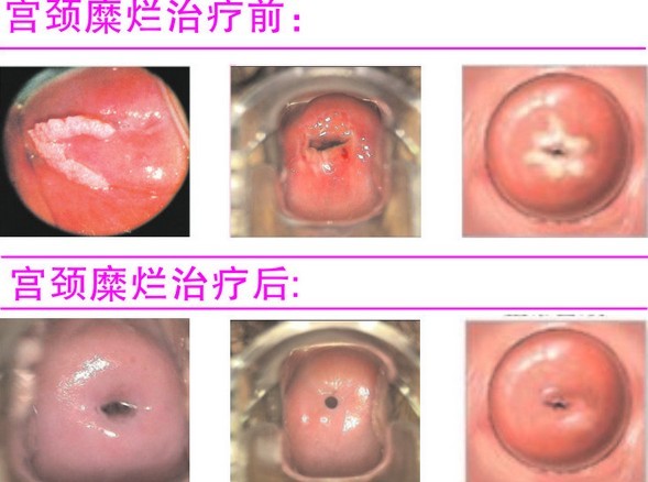 宫颈糜烂