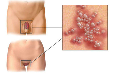 燕郊男性生殖器疱疹的预防方法
