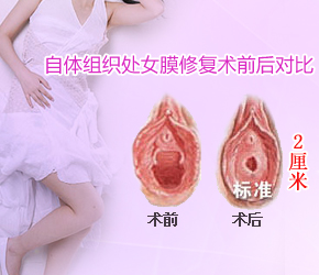 在西宁哪家医院做处女膜修复术最逼真