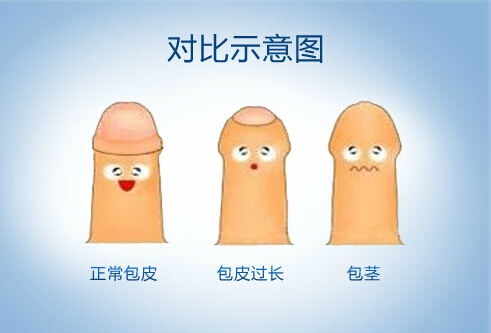 西宁哪个医院做包皮手术