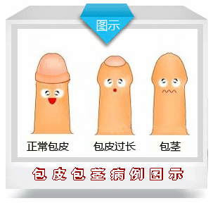 西宁做完包皮手术