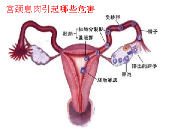 西宁怎么样治疗宫颈息肉