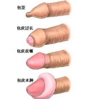西宁包皮上长疙瘩
