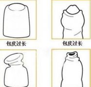 西宁男性包皮过长患者一般都有哪些过长原因