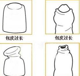 西宁包皮手术哪家好 