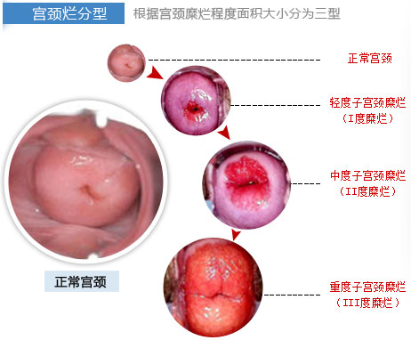 宫颈糜烂 宫颈糜烂的症状有哪些