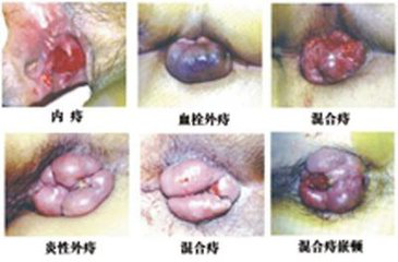 西宁最好的痔疮医院是哪家 哪家医院治疗痔疮最好 治疗痔疮的医院有哪家