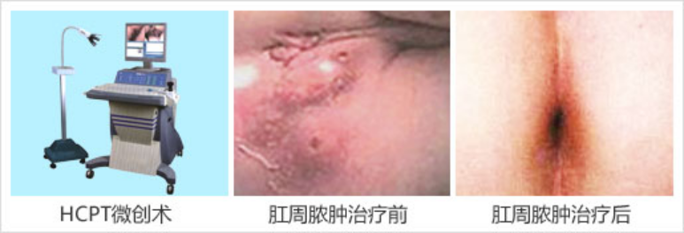 肛瘘症状是什么