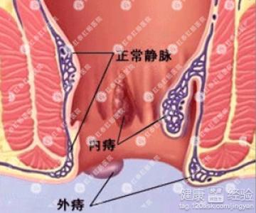 痔疮 痔疮的症状