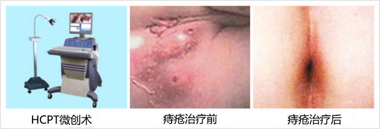 治疗痔疮的最佳方法