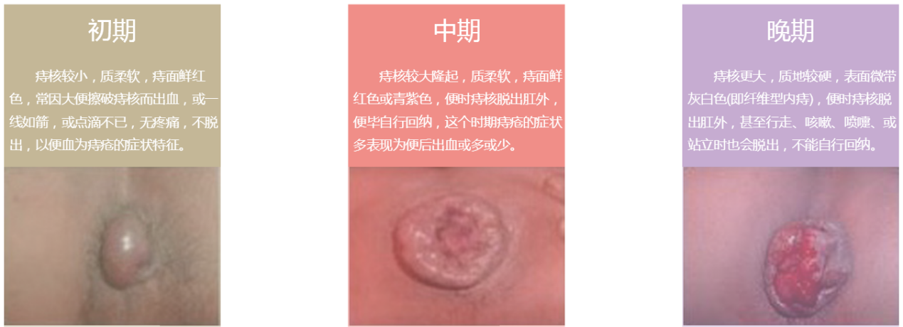 治疗痔疮的最佳方法