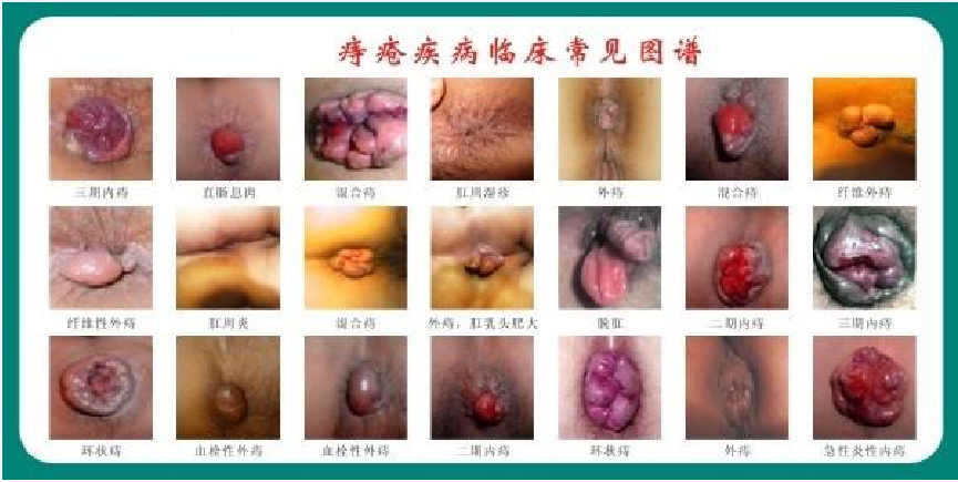 痔疮 燕郊治疗痔疮医院哪家好