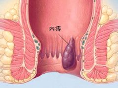 如何预防内痔的哪些方法