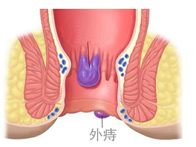 外痔需要做什么检查
