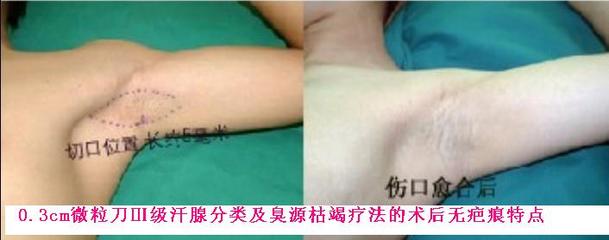 腋臭难闻怎么办