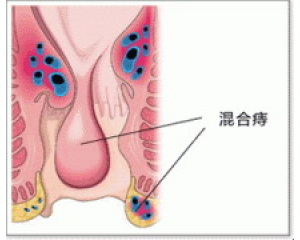 混合痔的表现是什么