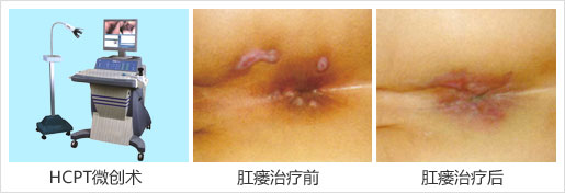 治疗肛瘘的费用是多少
