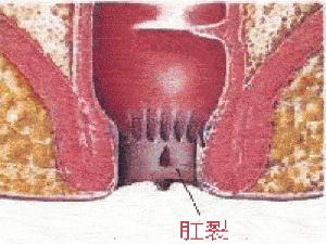 肛裂了怎么办？