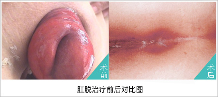 脱肛的最佳治疗方法