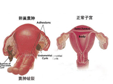 卵巢囊肿的症状有哪些？