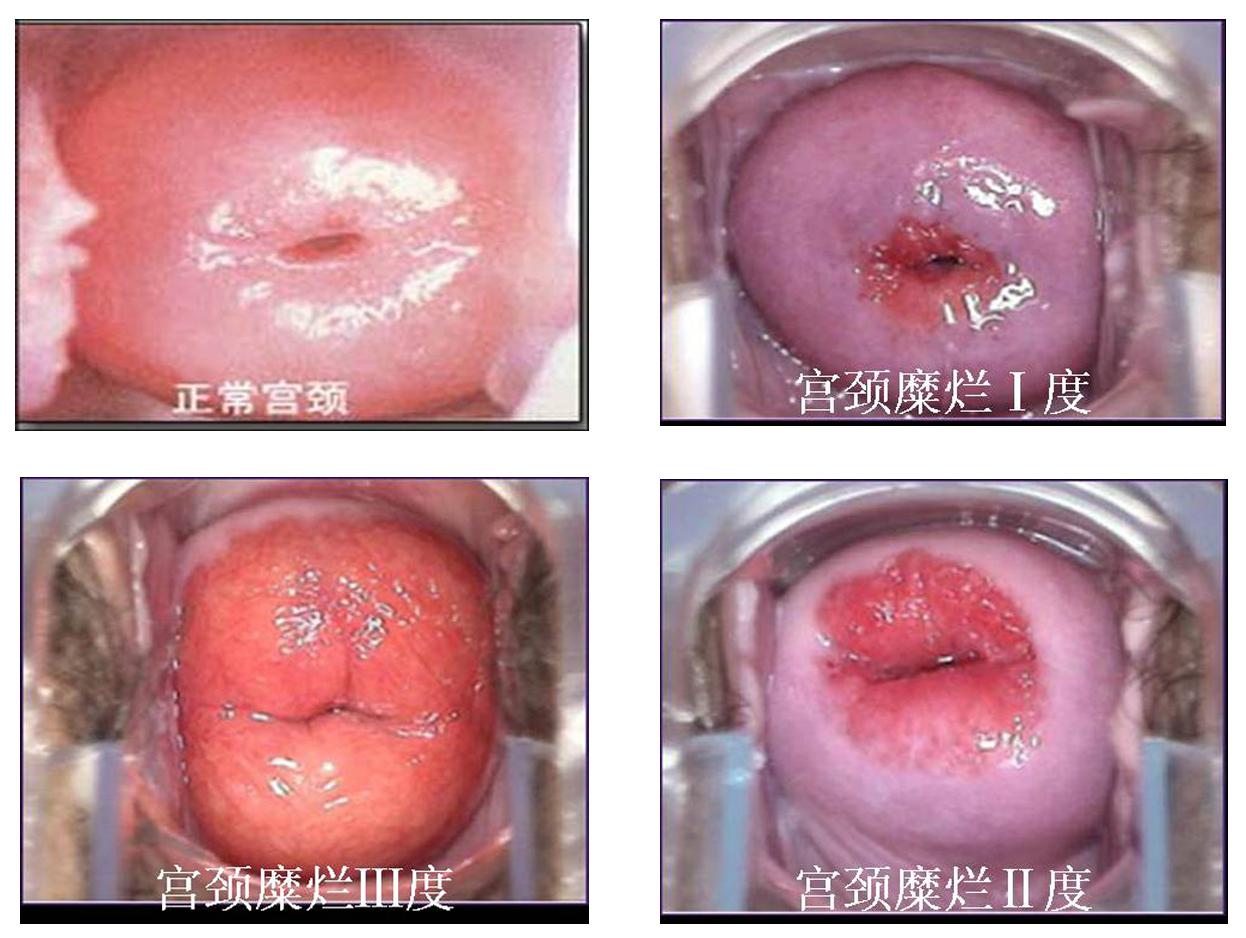 宫颈糜烂的症状有哪些？