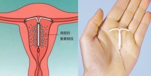 什么时候取环好？
