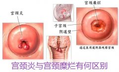 防治慢性宫颈炎要怎么做呢