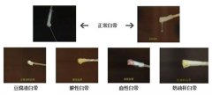妇科白带异常疾病需要警惕